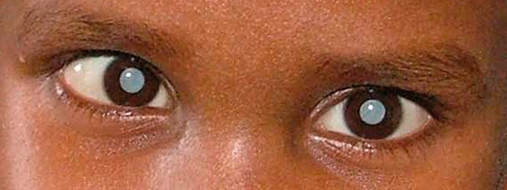 patiet_with_bilateral_cataracts